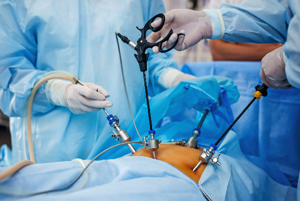 Laparoscopic Myomectomy
